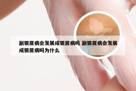 副银屑病会发展成银屑病吗 副银屑病会发展成银屑病吗为什么