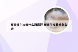 顽固性牛皮癣什么药最好 顽固牛皮肤癣怎么治