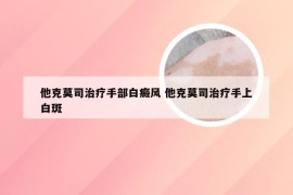 他克莫司治疗手部白癜风 他克莫司治疗手上白斑