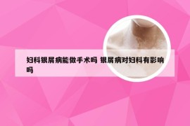 妇科银屑病能做手术吗 银屑病对妇科有影响吗