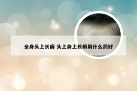 全身头上长癣 头上身上长癣用什么药好