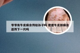 爷爷有牛皮癣会传给孙子吗 爸爸牛皮肤癣会遗传下一代吗