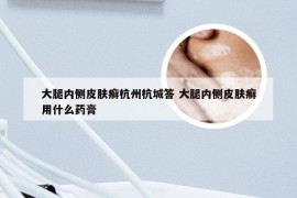 大腿内侧皮肤癣杭州杭城答 大腿内侧皮肤癣用什么药膏