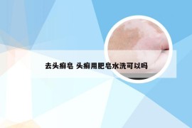 去头癣皂 头癣用肥皂水洗可以吗