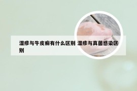 湿疹与牛皮癣有什么区别 湿疹与真菌感染区别