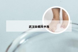 武汉白癜风中海