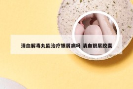 清血解毒丸能治疗银屑病吗 清血银屑胶囊