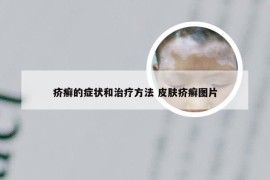 疥癣的症状和治疗方法 皮肤疥癣图片