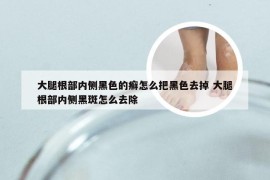 大腿根部内侧黑色的癣怎么把黑色去掉 大腿根部内侧黑斑怎么去除