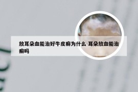 放耳朵血能治好牛皮癣为什么 耳朵放血能治癣吗