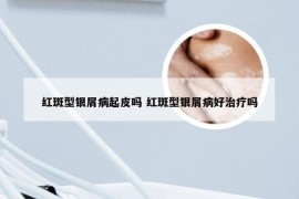 红斑型银屑病起皮吗 红斑型银屑病好治疗吗