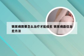 银屑病需要怎么治疗才能痊愈 银屑病最佳治愈方法