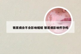 银屑病会不会影响婚姻 银屑病影响怀孕吗