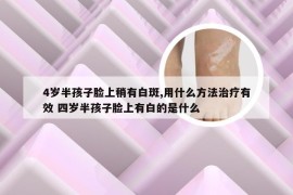 4岁半孩子脸上稍有白斑,用什么方法治疗有效 四岁半孩子脸上有白的是什么