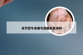 关节型牛皮癣与尿酸高有关吗