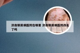 济南银屑病医院在哪里 济南银屑病医院改名了吗