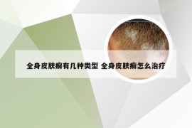 全身皮肤癣有几种类型 全身皮肤癣怎么治疗