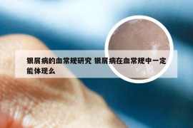 银屑病的血常规研究 银屑病在血常规中一定能体现么