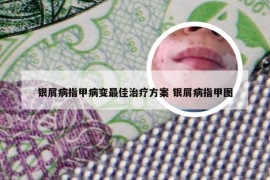 银屑病指甲病变最佳治疗方案 银屑病指甲图