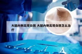 大腿内侧出现白斑 大腿内侧出现白斑怎么治疗