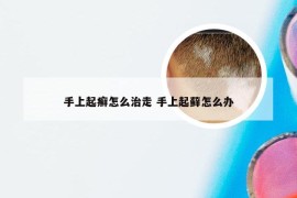 手上起癣怎么治走 手上起藓怎么办