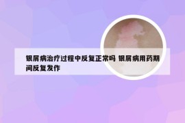 银屑病治疗过程中反复正常吗 银屑病用药期间反复发作