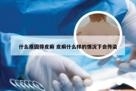 什么原因得皮癣 皮癣什么样的情况下会传染