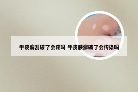 牛皮癣刮破了会疼吗 牛皮肤癣破了会传染吗