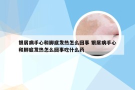 银屑病手心和脚底发热怎么回事 银屑病手心和脚底发热怎么回事吃什么药