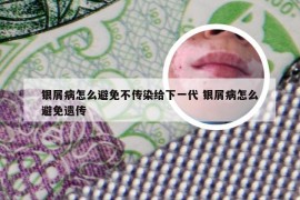 银屑病怎么避免不传染给下一代 银屑病怎么避免遗传