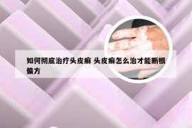 如何彻底治疗头皮癣 头皮癣怎么治才能断根偏方