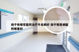 南宁有哪家医院治疗牛皮癣好 南宁银屑病医院哪里好