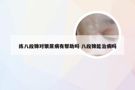 练八段锦对银屑病有帮助吗 八段锦能治病吗