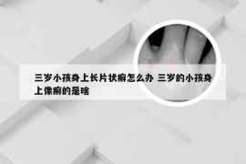 三岁小孩身上长片状癣怎么办 三岁的小孩身上像癣的是啥