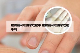 银屑病可以偶尔吃肥牛 银屑病可以偶尔吃肥牛吗