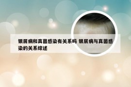 银屑病和真菌感染有关系吗 银屑病与真菌感染的关系综述