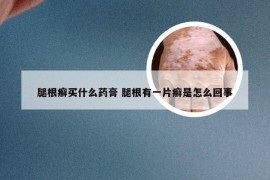 腿根癣买什么药膏 腿根有一片癣是怎么回事