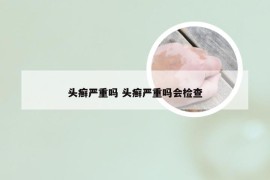 头癣严重吗 头癣严重吗会检查