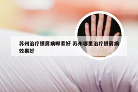 苏州治疗银屑病哪家好 苏州哪里治疗银屑病效果好