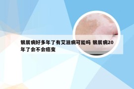 银屑病好多年了有艾滋病可能吗 银屑病20年了会不会癌变