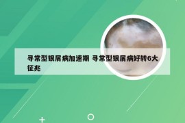 寻常型银屑病加速期 寻常型银屑病好转6大征兆