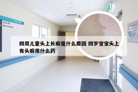 四周儿童头上长癣是什么原因 四岁宝宝头上有头癣用什么药