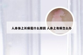 人身体上长癣是什么原因 人身上有癣怎么办