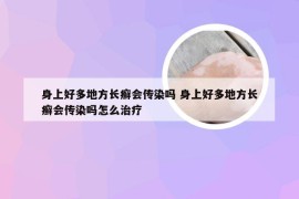 身上好多地方长癣会传染吗 身上好多地方长癣会传染吗怎么治疗