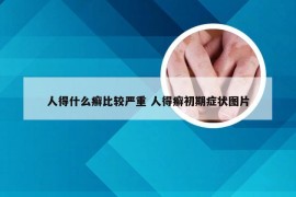 人得什么癣比较严重 人得癣初期症状图片