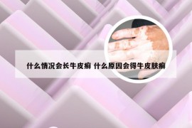 什么情况会长牛皮癣 什么原因会得牛皮肤癣