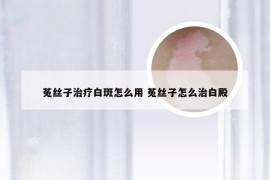 菟丝子治疗白斑怎么用 菟丝子怎么治白殿