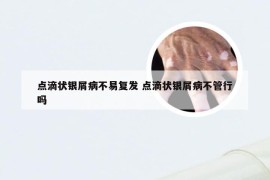 点滴状银屑病不易复发 点滴状银屑病不管行吗