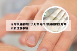 冶疗银屑病有什么好的光疗 银屑病的光疗知识和注意事项