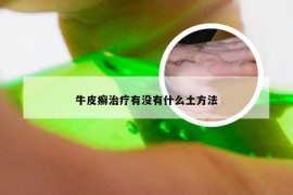 牛皮癣治疗有没有什么土方法